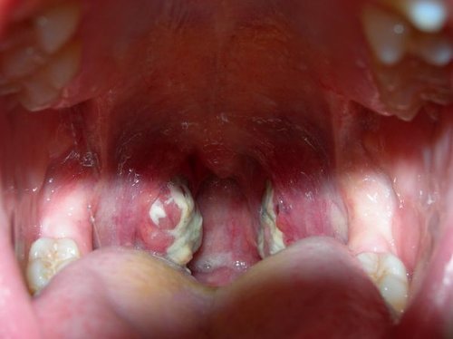 Hình minh họa từ tonsils - amidan vòm họng