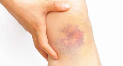 Hình minh họa từ Bruise - Vết bầm tím